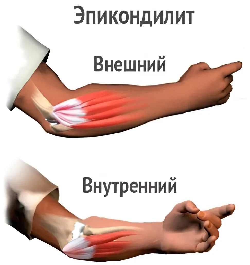 Эпикондилит или «локоть теннисиста»: что это такое и как лечить?