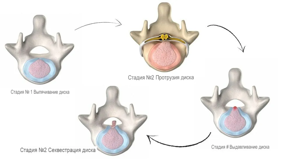 Этапы формирования межпозвоночной грыжи