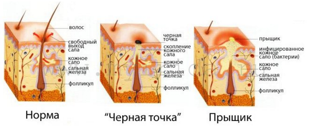 акне признаки и лечение акне