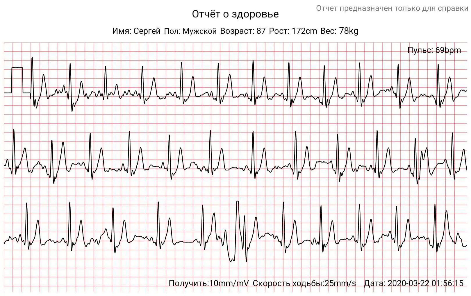 HEALTHBAND-EKG-WM17