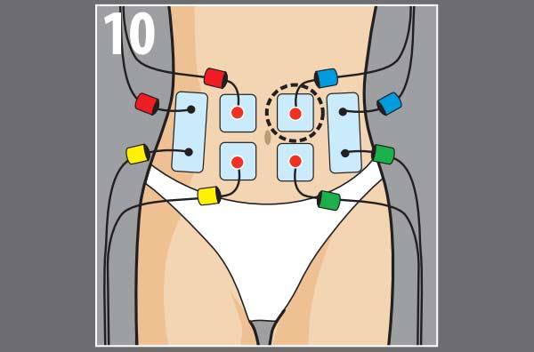 Миостимуляция живота схема наложения электродов