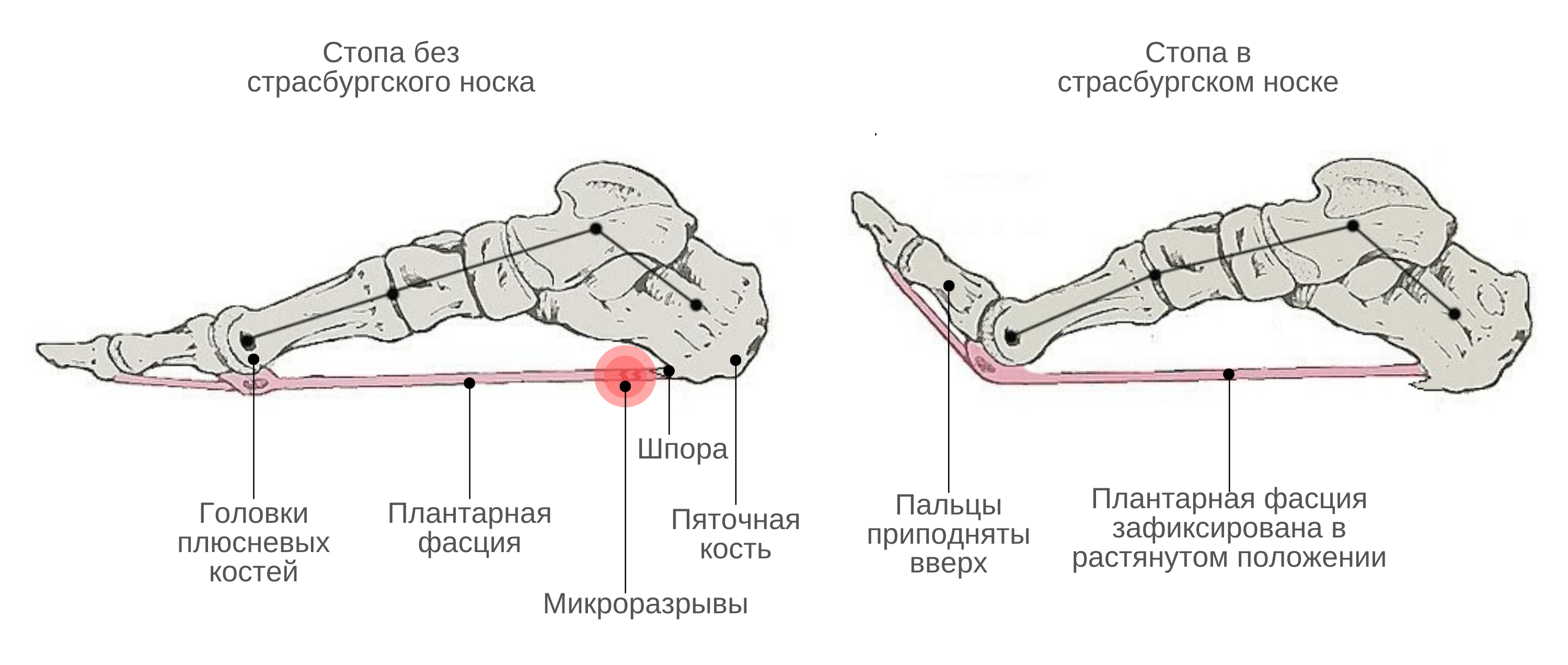 Носок для пяточной шпоры. Страсбургский носок. Страсбургский носок при пяточной шпоре. Носок для лечения пяточной шпоры.