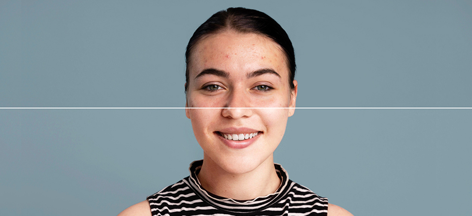 problemnaya-kozha-lica problemnaya-kozha-lica.jpg