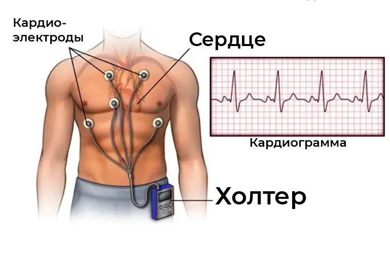 Схема размещения электродов для холтер‑мониторирования
