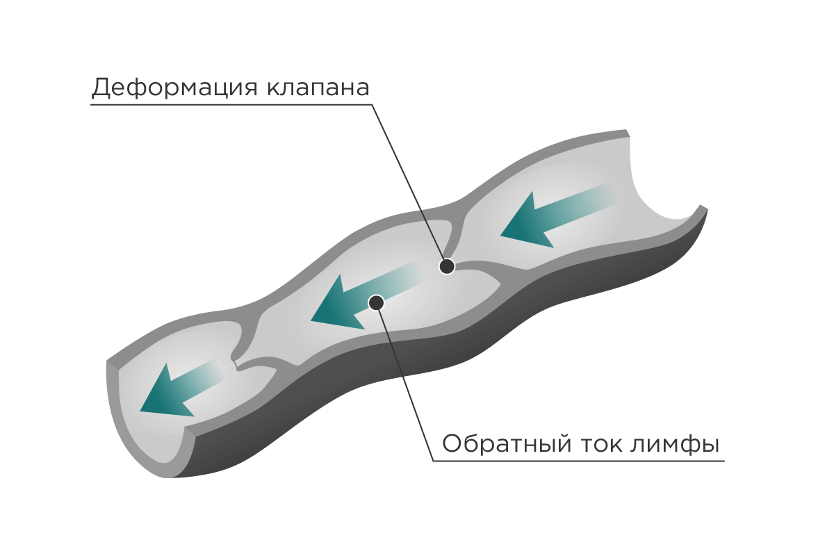 болезни лимфатической системы