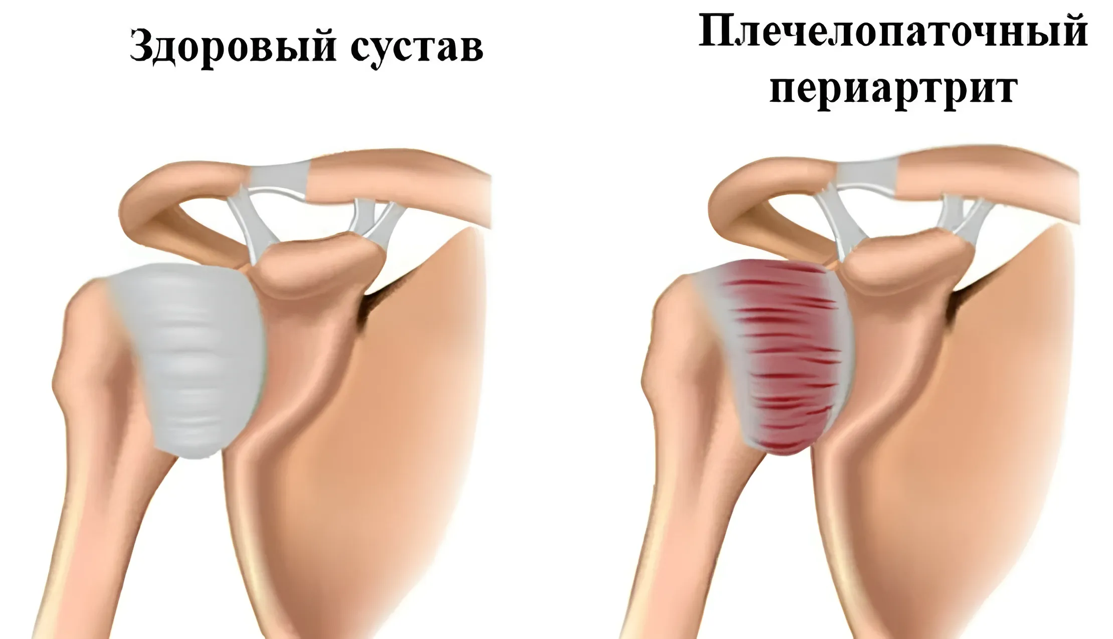 Плечелопаточный периартрит | Что это такое и какой врач лечит плечевой  сустав