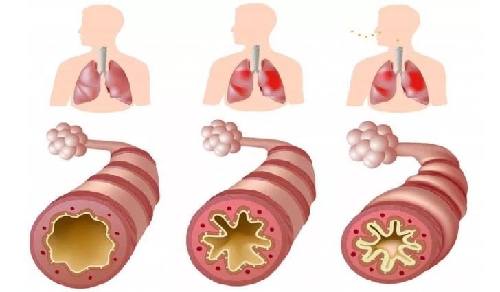 Бронхиальная астма: лечение, симптомы, виды, формы, стадии | Солнышко