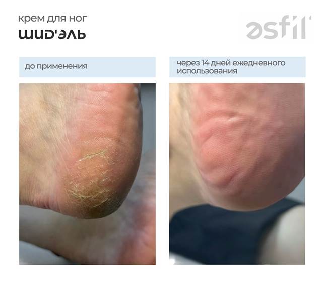 крем для ног до после