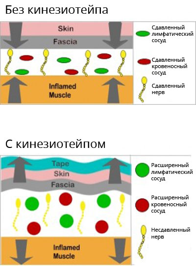 Как кинезиотейп борется с отеками и синяками