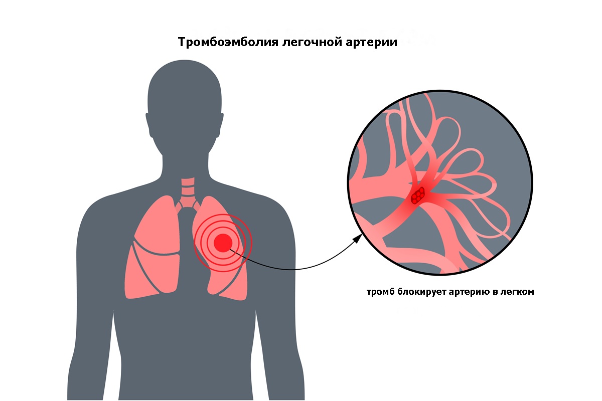 Какой врач лечит тромбоз селезеночной вены