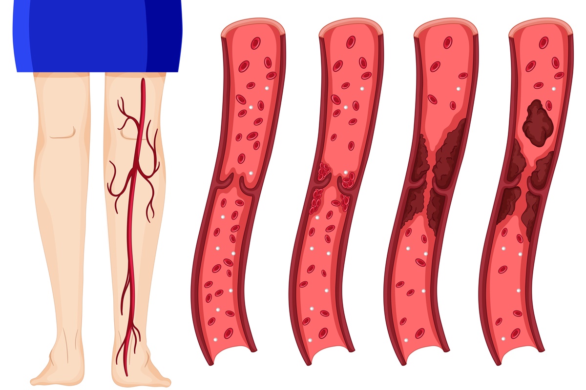 Тромбоэмболия легочной артерии (ТЭЛА) - Легочные нарушения - Справочник MSD Профессиональная версия