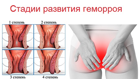 Стадии развития геморроя