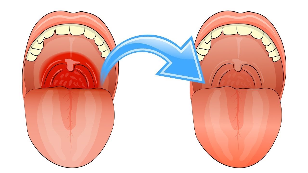 Лечение тонзиллита