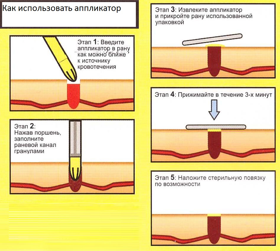 Как использовать кровоостанавливающий аппликатор (шприц) Celox