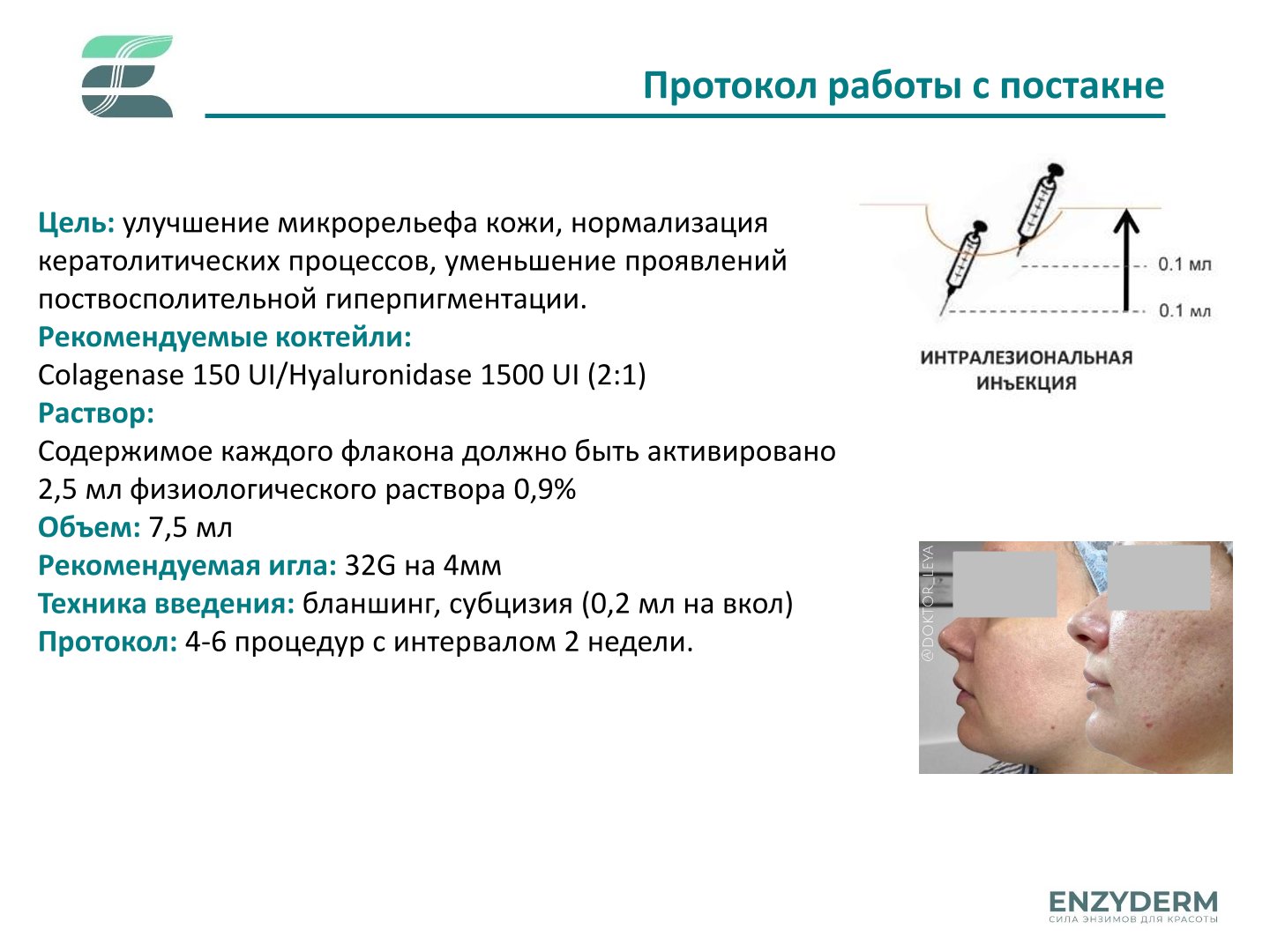 Hyaluronidase 1500 UI Enzyderm