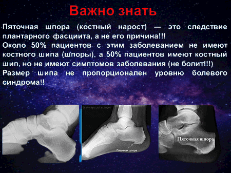 Причина возникновения_пяточной_шпоры