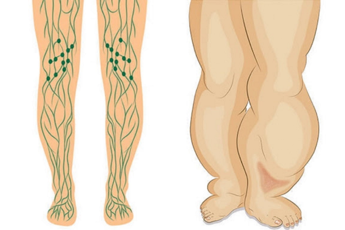 Как разогнать отеки ногах лимфу. Лимфостаз застой лимфы.