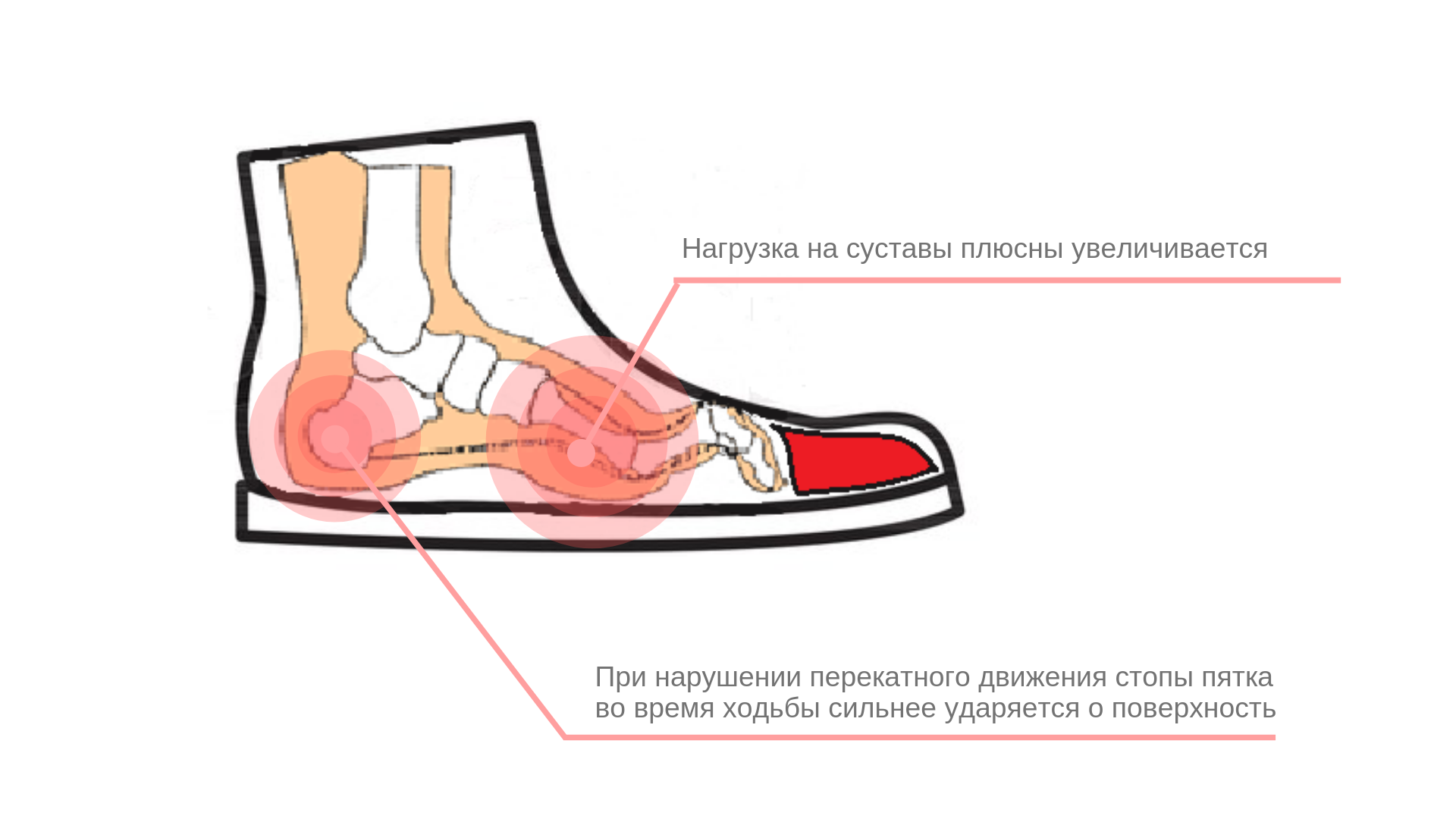 Что делать, если натирает обувь - полезные советы