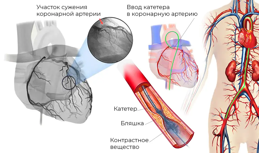 invazivnaya-koronarografiya Инвазивная коронарография
