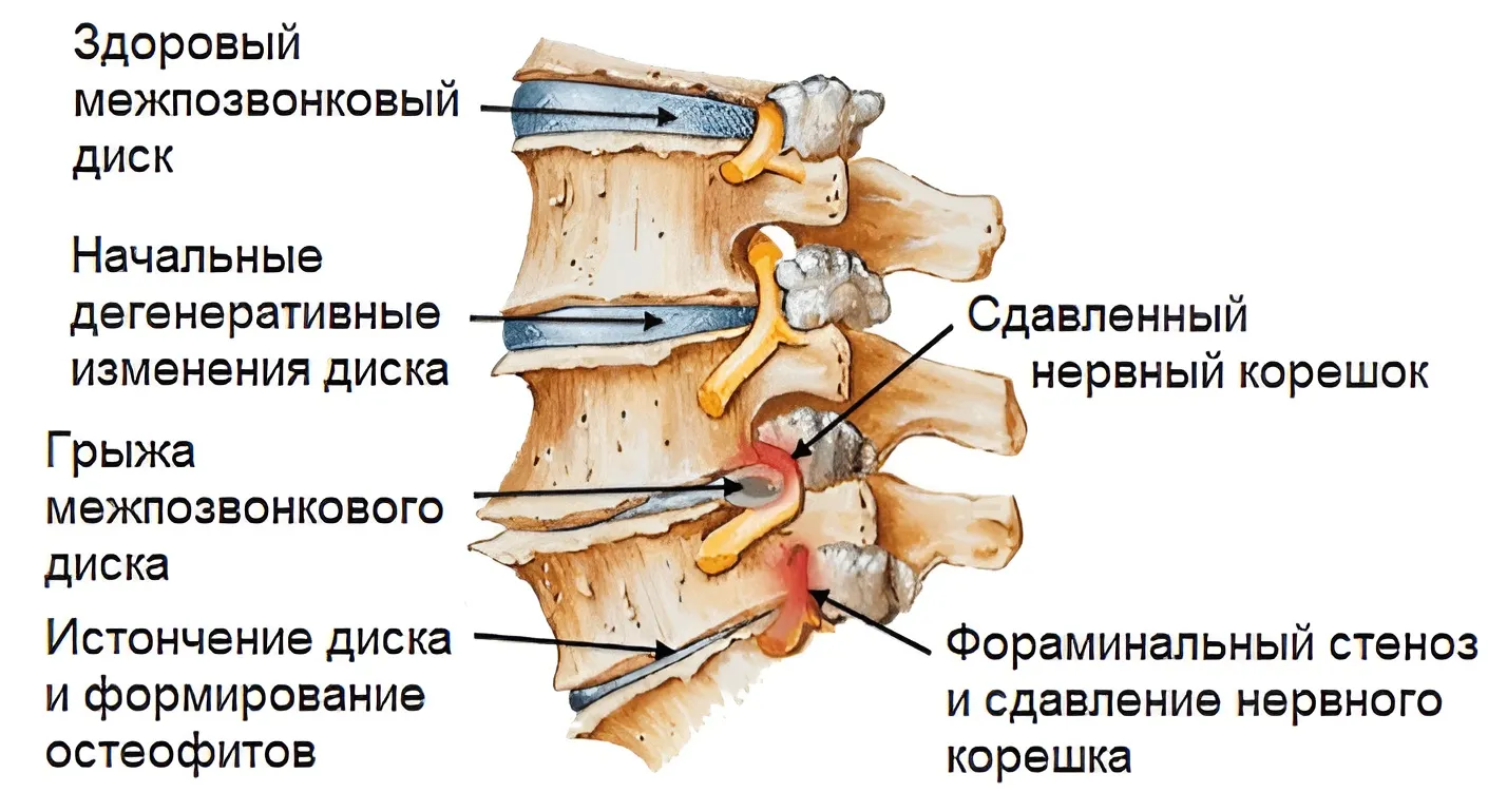 Операция на грыжу диска L4-L5 (грубая компрессия корешка и иррадиацией в левую ногу)