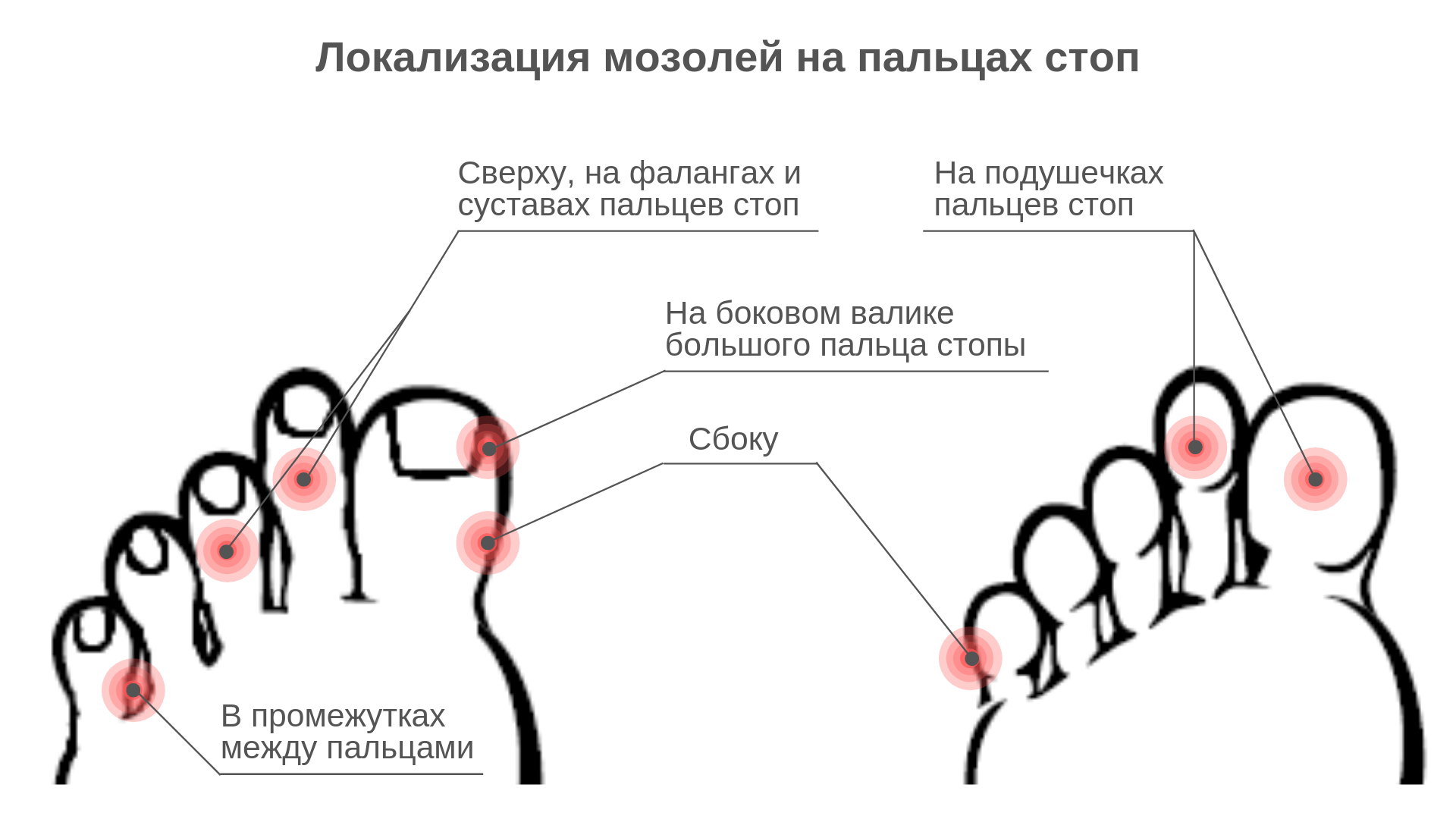 Места пальчика. Стержневая мозоль на пальце ноги сбоку. Стержневая мозоль между пальцев. Мозоль между пальцами ног. Мозоли на подушечках ног причины.