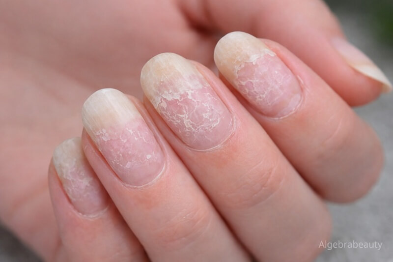 Повреждённые ногти после снятия гель-лака &mdash; истончённая пластина и отслоения у кутикулы