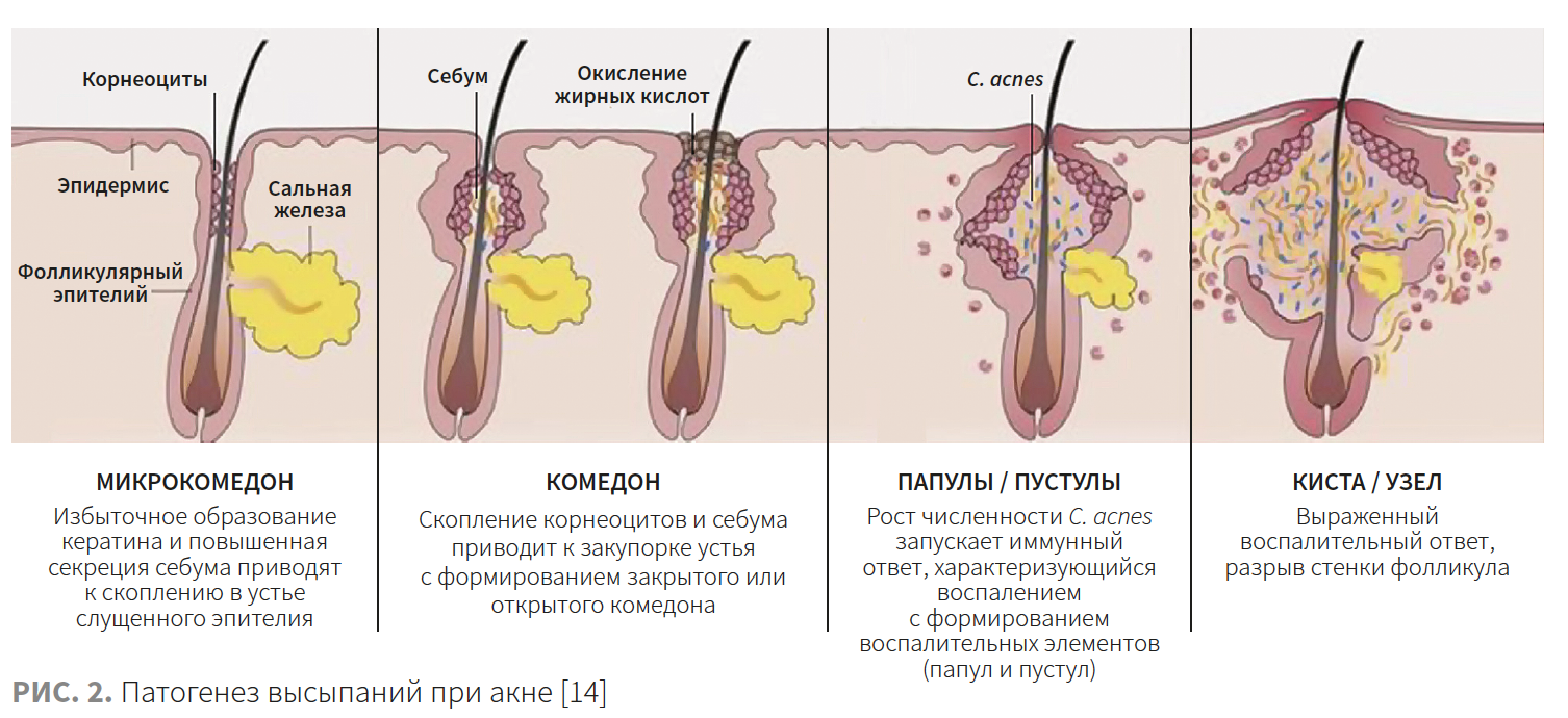 Топические стероиды для носа