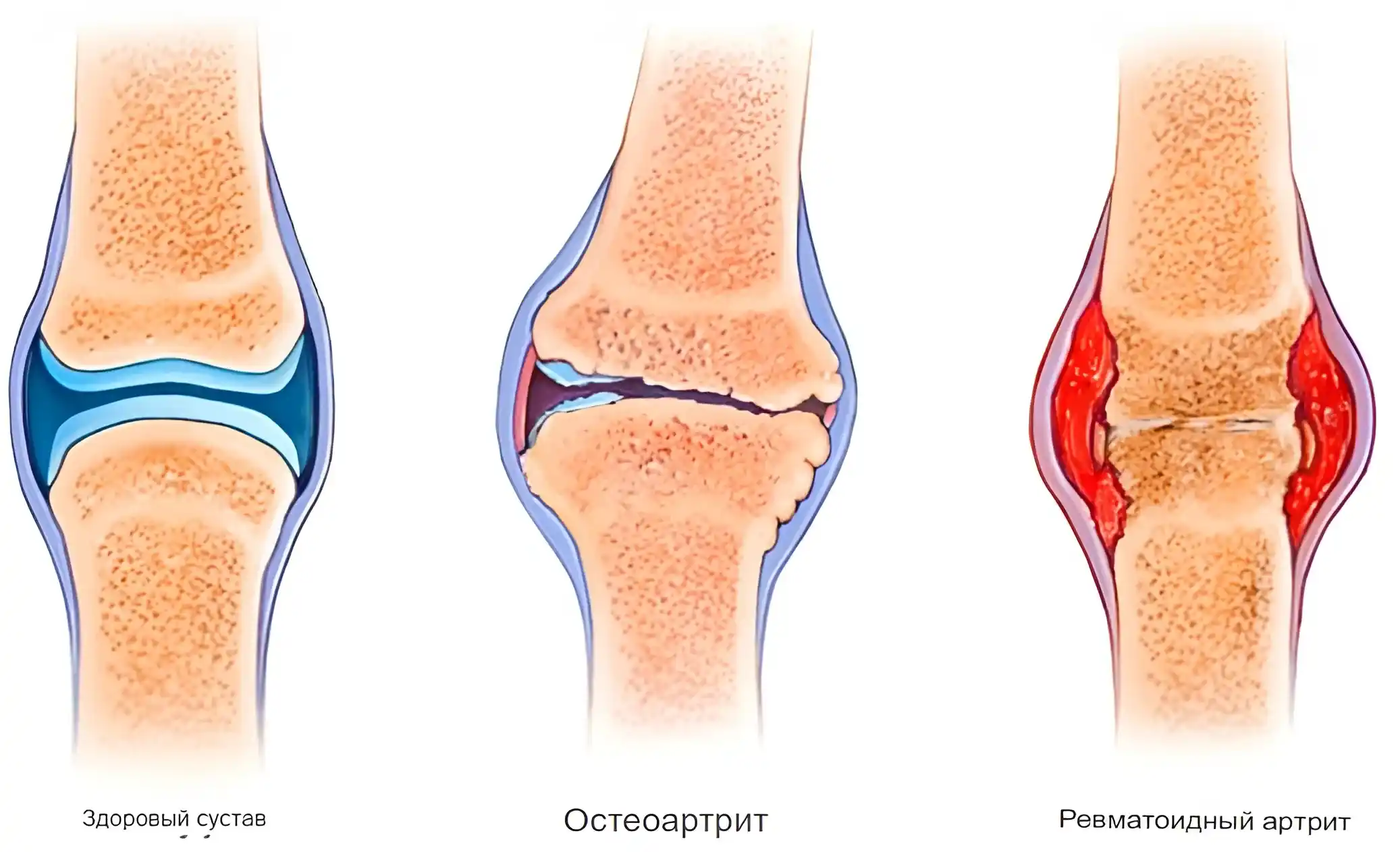 Что значит артрит. Остеоартрит и ревматоидный артрит. Ревматоидный артрит суставы. Ревматоидный артрит колена. Суставная форма ревматоидного артрита.