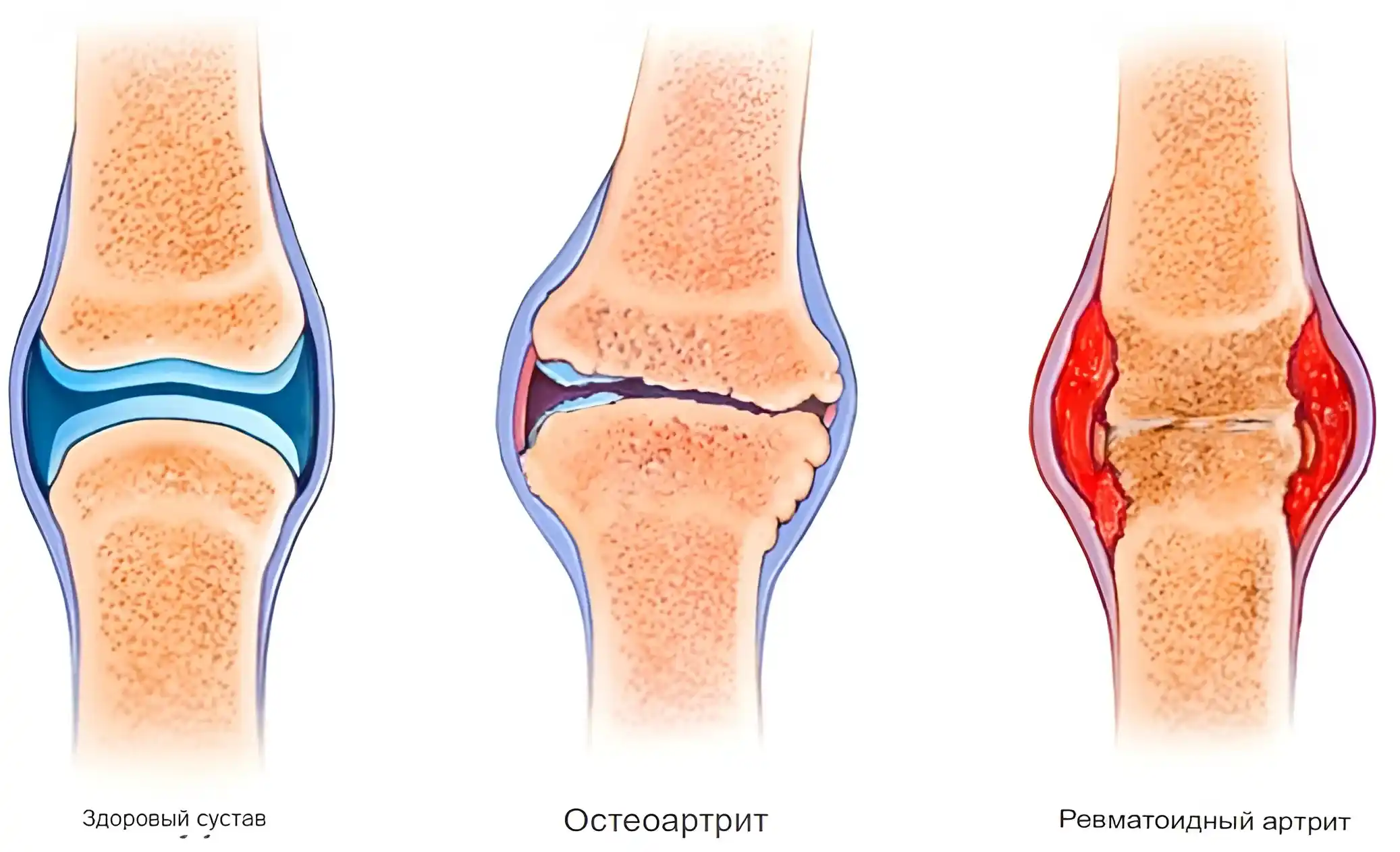 Артрит коленного сустава: симптоматика и лечение