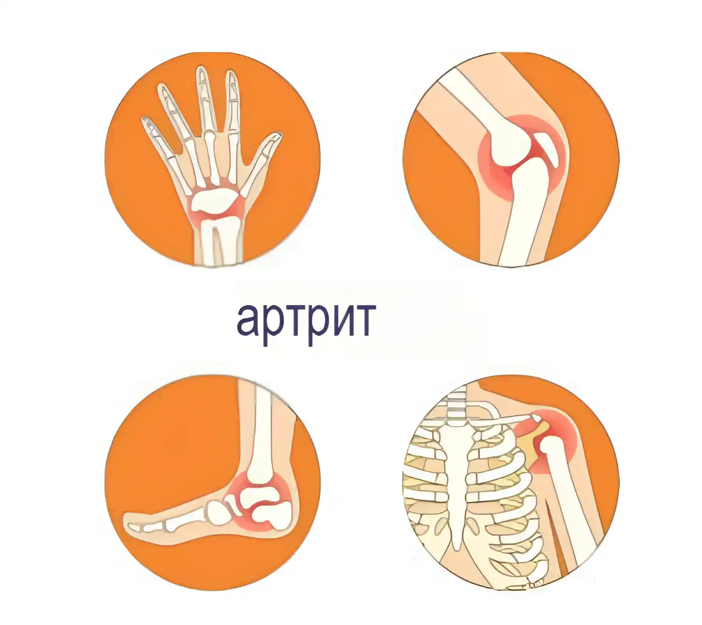 Симптомы артрита