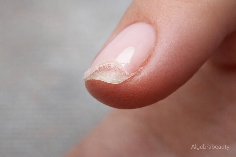 Расслоение ногтя на свободном крае после гель-лака &mdash; повреждение и отслойка покрытия