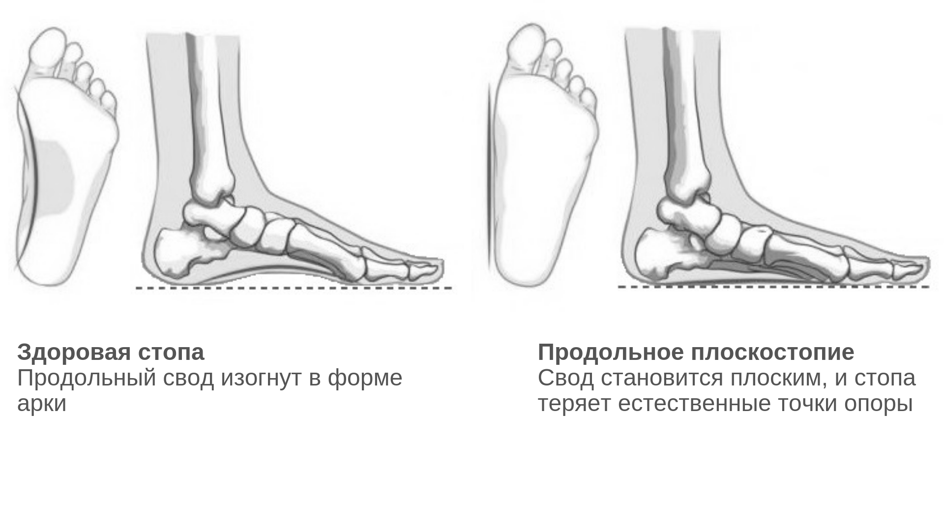 Плоскостопие: лечить, нельзя откладывать