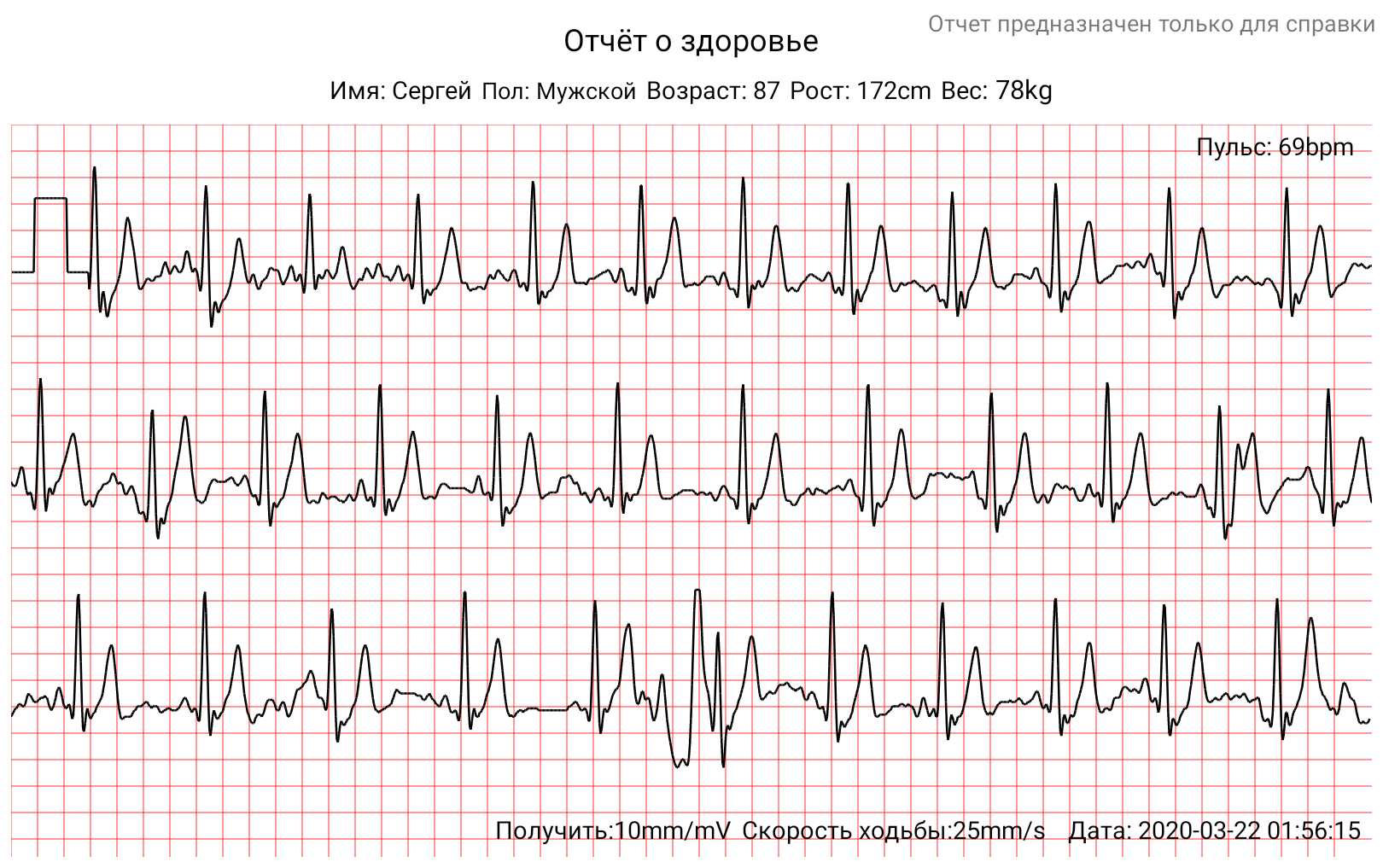 EKG-HEALTHBAND