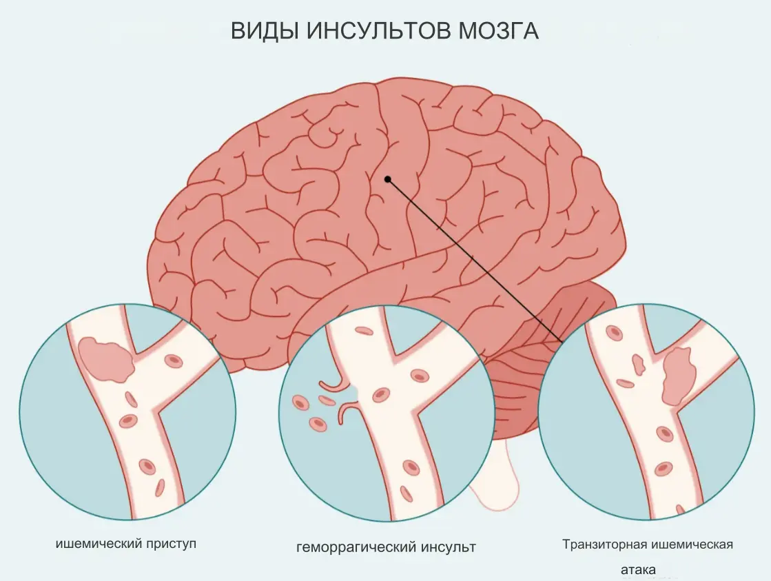 Эмболический инсульт. Транзиторные ишемические атаки. Тиа инсульт. Транзитная ишемическая атака.