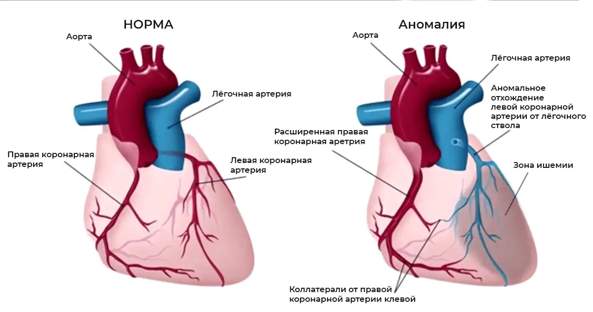 Аномалия коронарной артерии