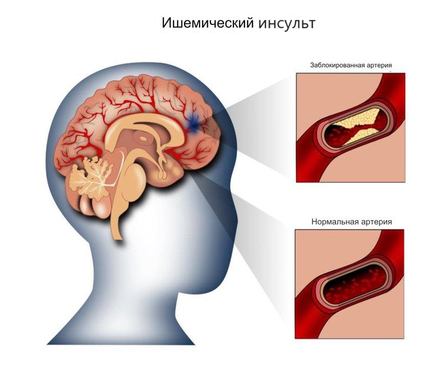 Ischemic stroke diagnosis. Stroke формы.