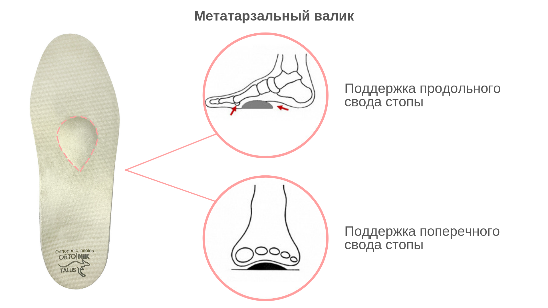 Как выглядят стельки при поперечном плоскостопии фото