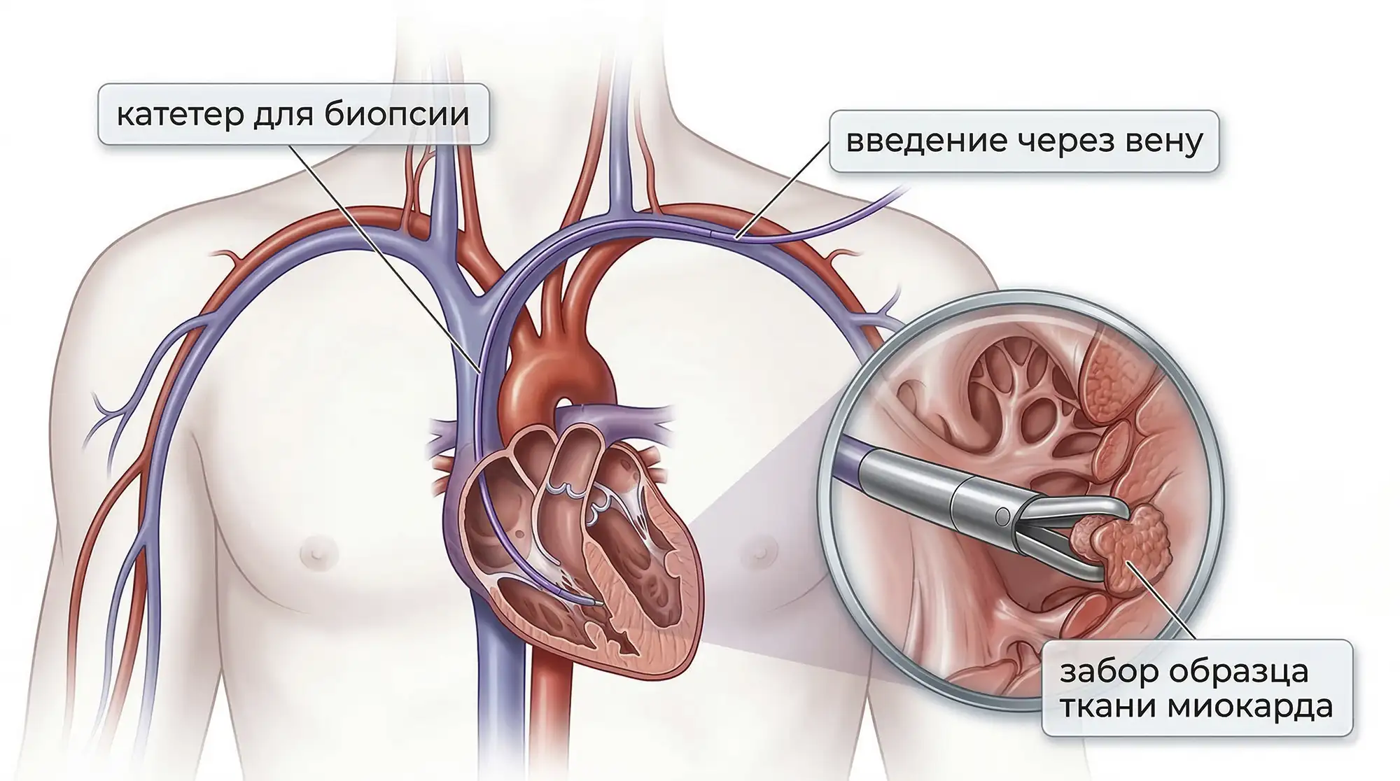Биопсия сердца