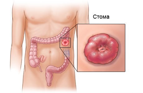 Поражение кожи при сахарном диабете