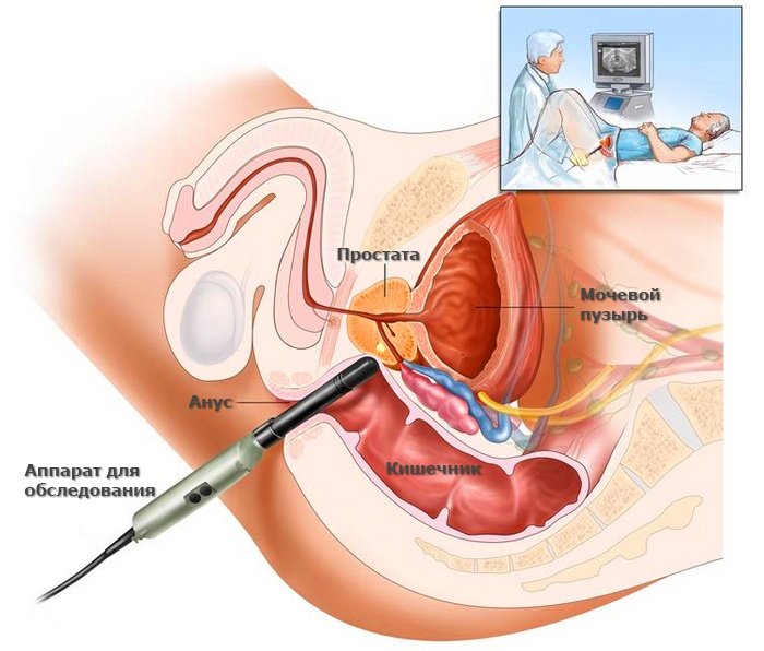 Симптомы простатита у мужчин | Признаки простаты, лечение и профилактика