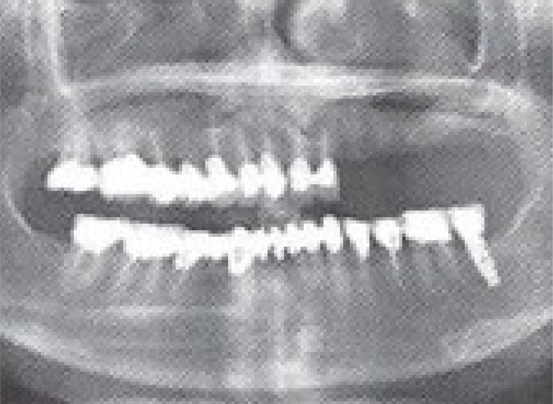 SorBone Syringe перед имплантацией.png