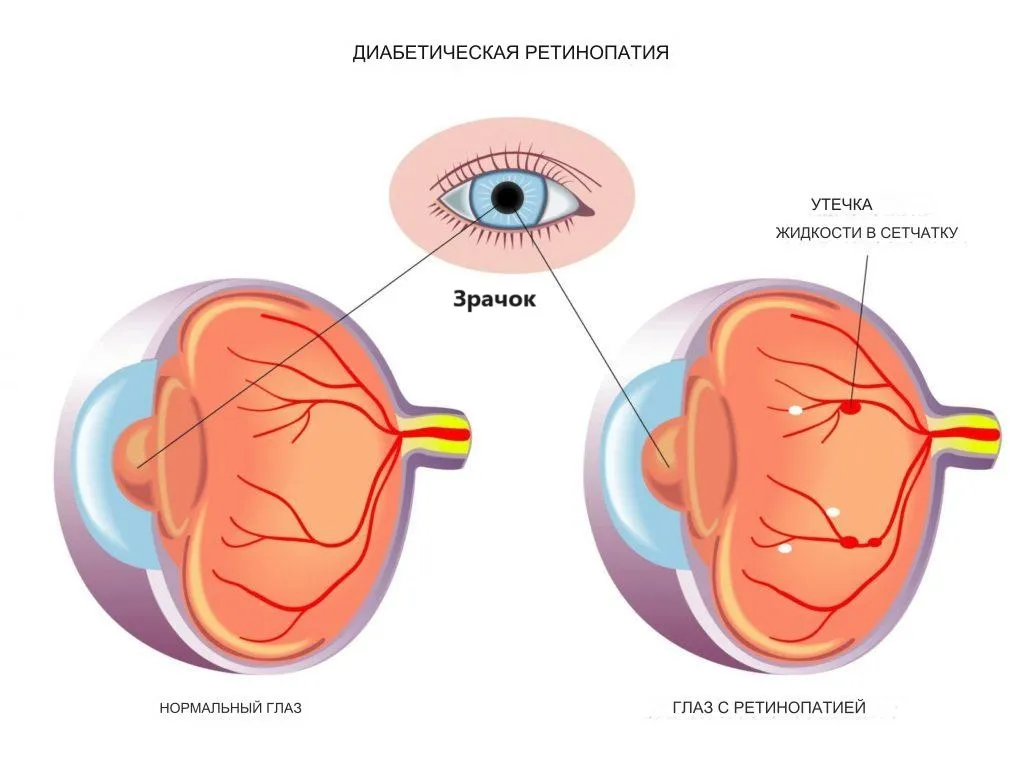 Глаз с диабетической ретинопатией