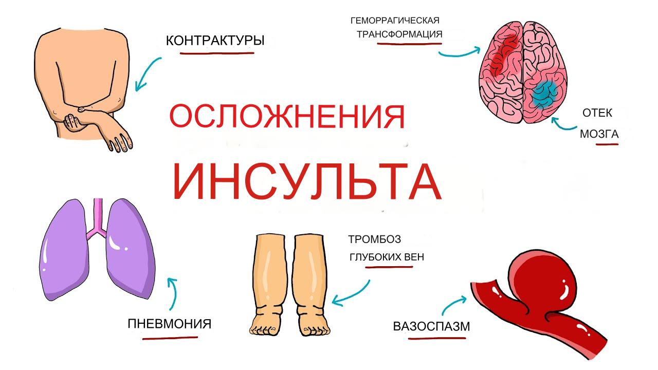 Осложнения инсульта