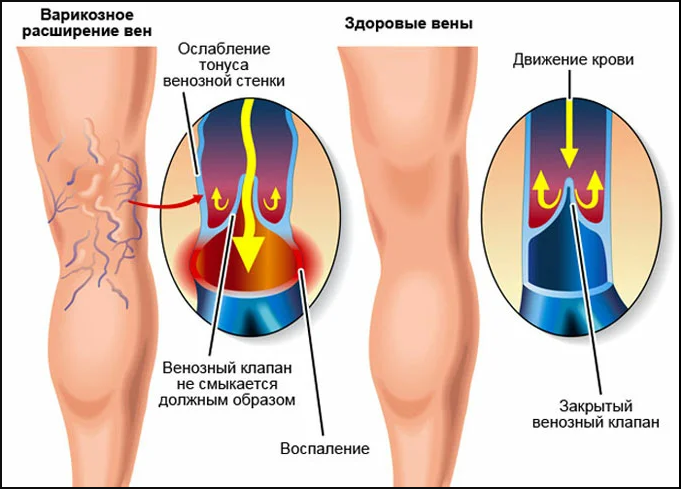 нога здорового человека и нога человека с варикозным расширением вен и несмыкающимися венозными клапанами