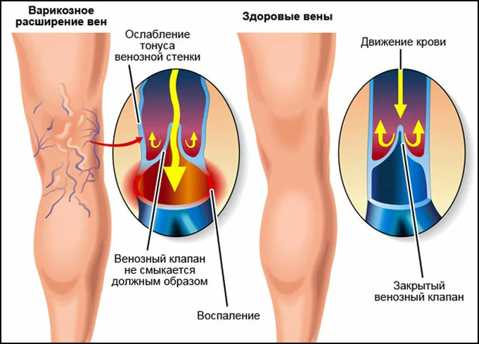 Тромбофлебит конечностей: симптомы и лечение