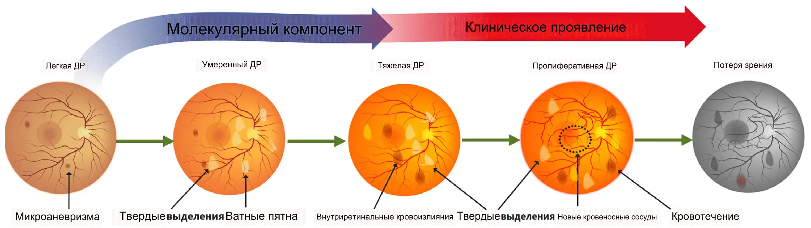 Стадии диабетической ретинопатии