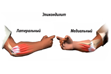Эпикондилит: симптомы, диагностика и лечение