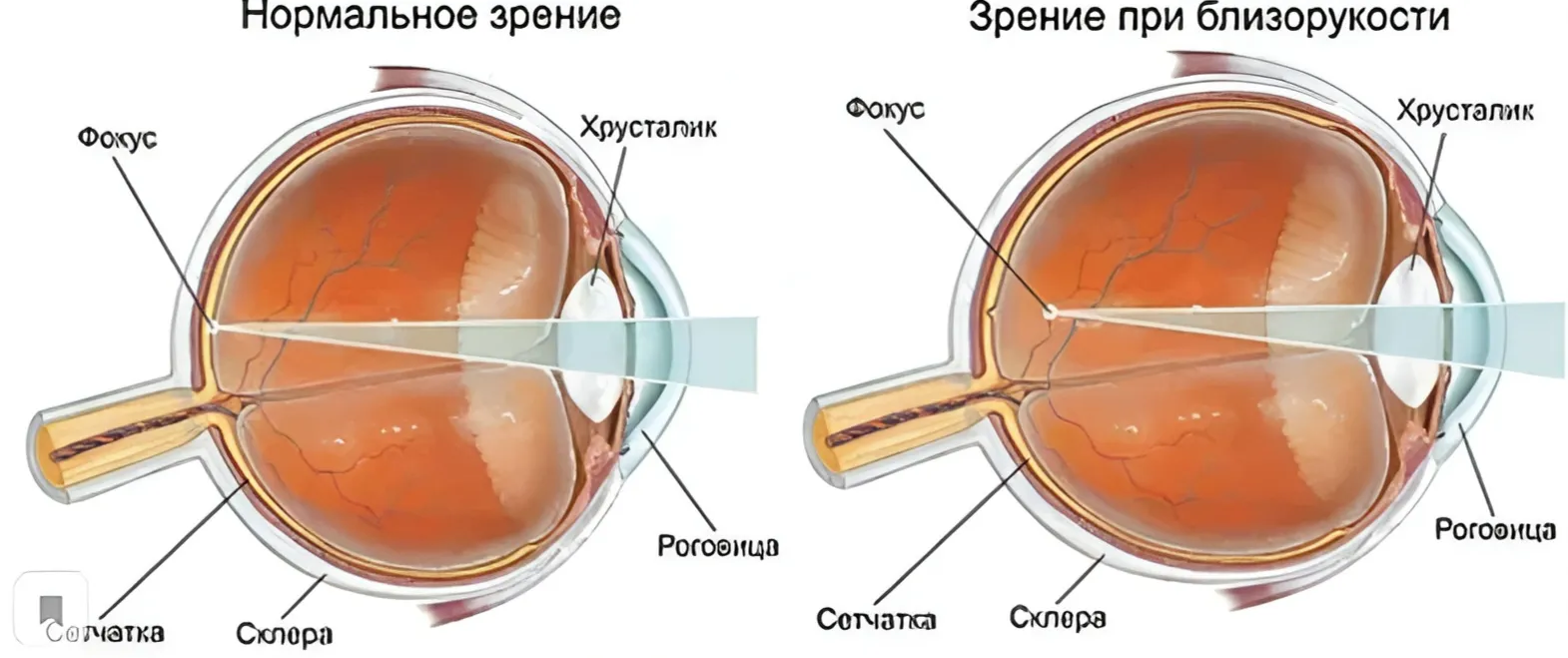 Миопия (Близорукость)