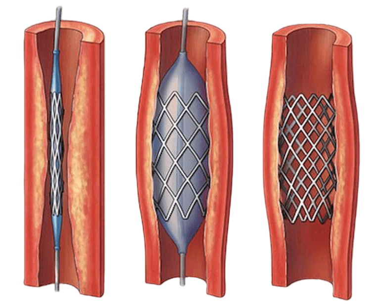 Скачай стентов. Баллонная ангиопластика сосудов сердца. Баллонная ангиопластика и стентирование. Коронарное стентирование сосудов сердца. Коронарная ангиопластика и стентирование.