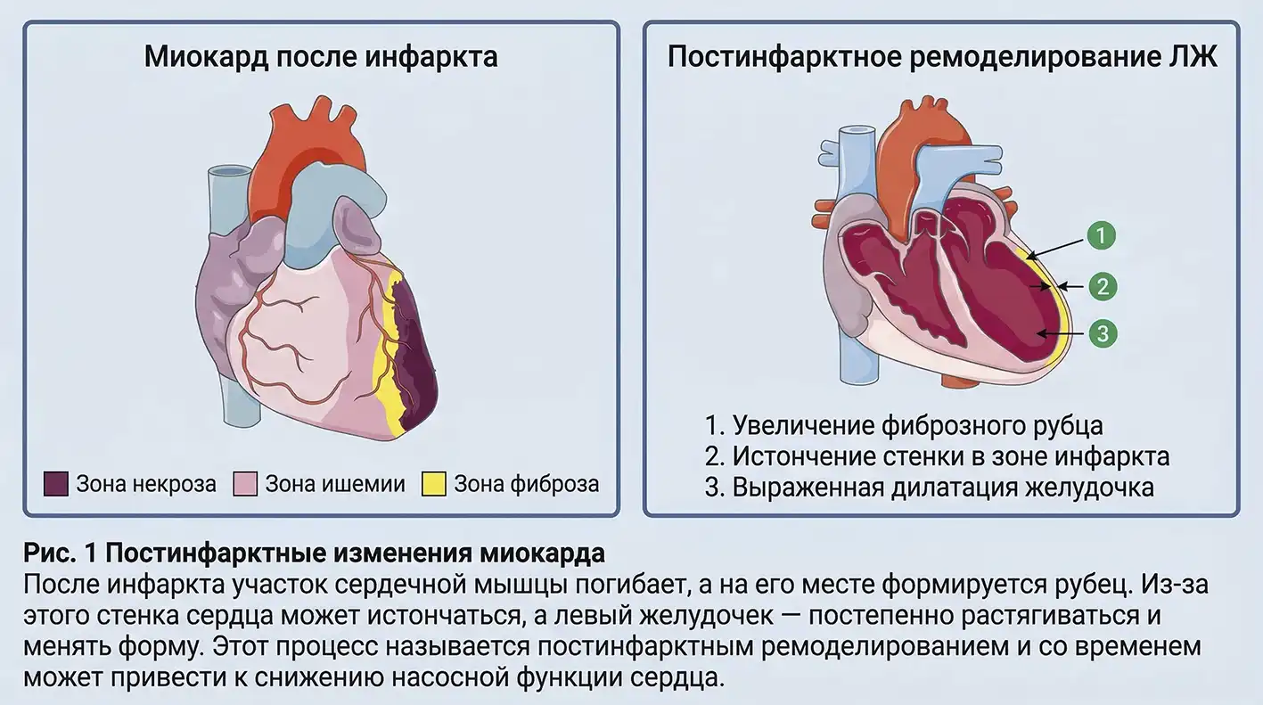 infarkt-miokarda-posledstviya